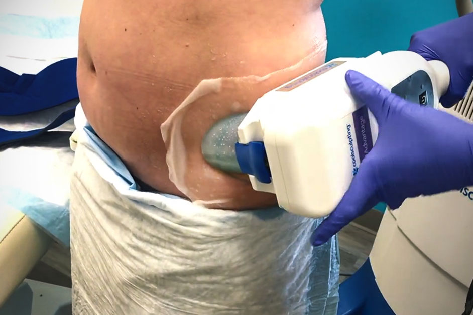 CoolSculpting Procedure