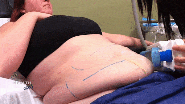 CoolSculpting Procedure - Gif 06