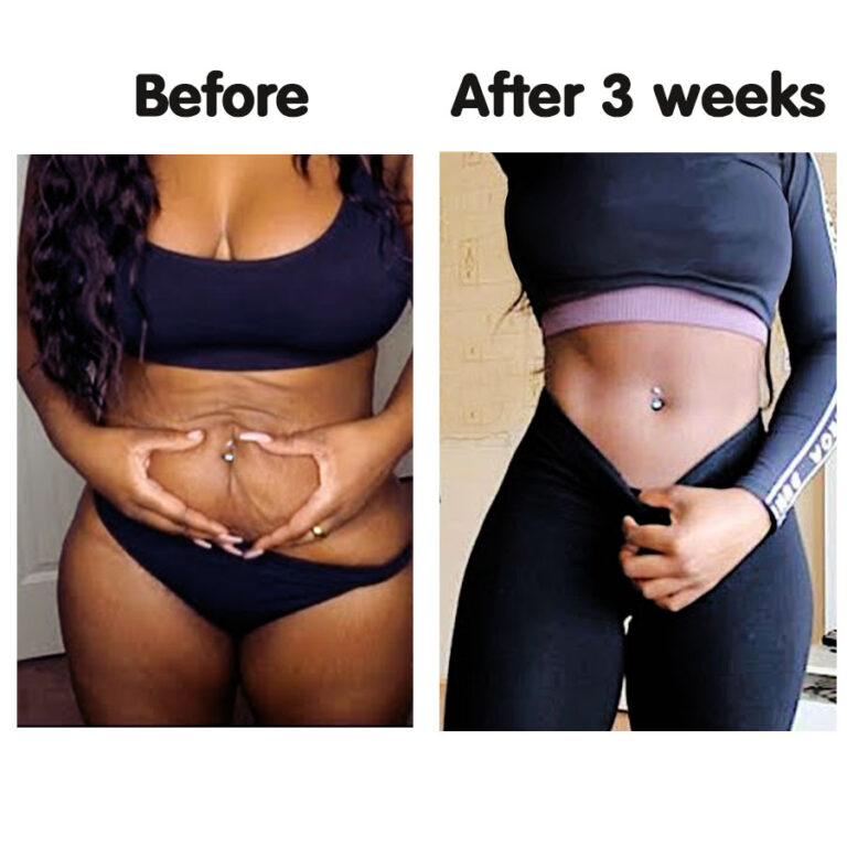 Fupa Loss Before and after Inspiration