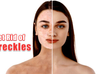 How To Get Rid of Freckles