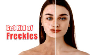How To Get Rid of Freckles