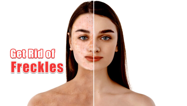 How To Get Rid of Freckles